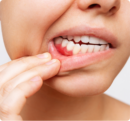 Comprendre les maladies des gencives Comprendre les maladies des gencives