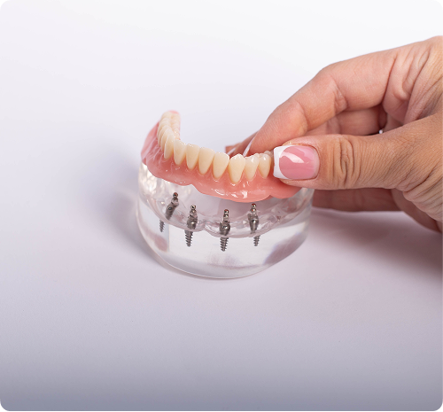 Prothèse dentaire Prothèse dentaire