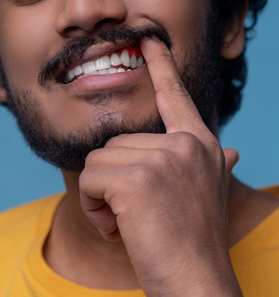 Pourquoi les gencives peuvent-elles s'infecter ? Pourquoi les gencives peuvent-elles s'infecter ?