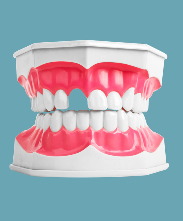 Pourquoi remplacer une dent manquante ? Pourquoi remplacer une dent manquante ?