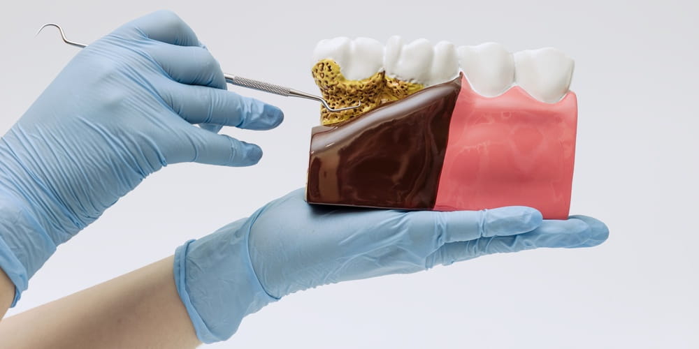 Un modèle dentaire montrant la gencive et l'os qui soutiennent les dents, les tissus dont le parodontiste est le spécialiste